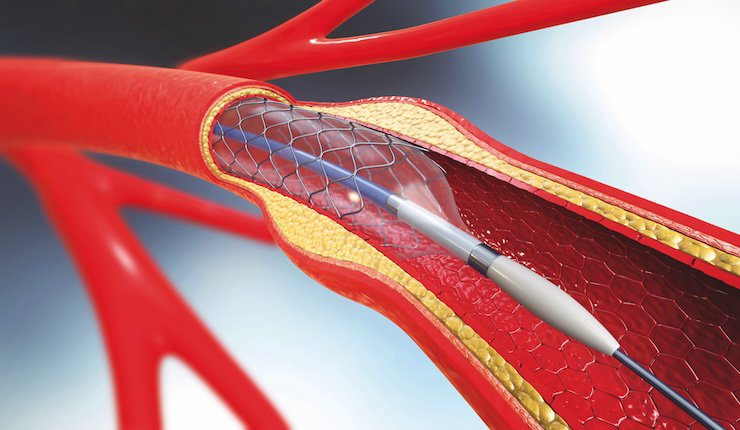 Catheter Stent (1).jpg